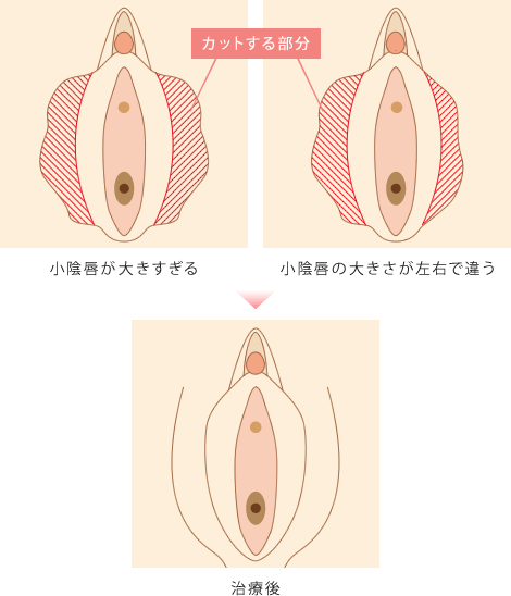 小陰唇縮小の立体的なデザイン