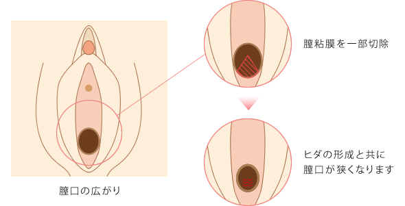 膣縮小術の流れ