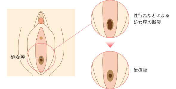 処女膜再生手術の流れ