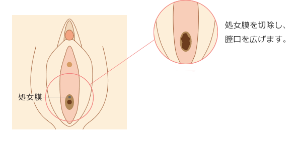 処女膜切除の流れ